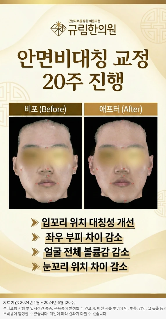 안면비대칭 윤곽 개선 전후