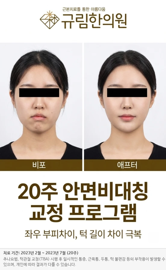 안면비대칭 턱관절 교정 전후