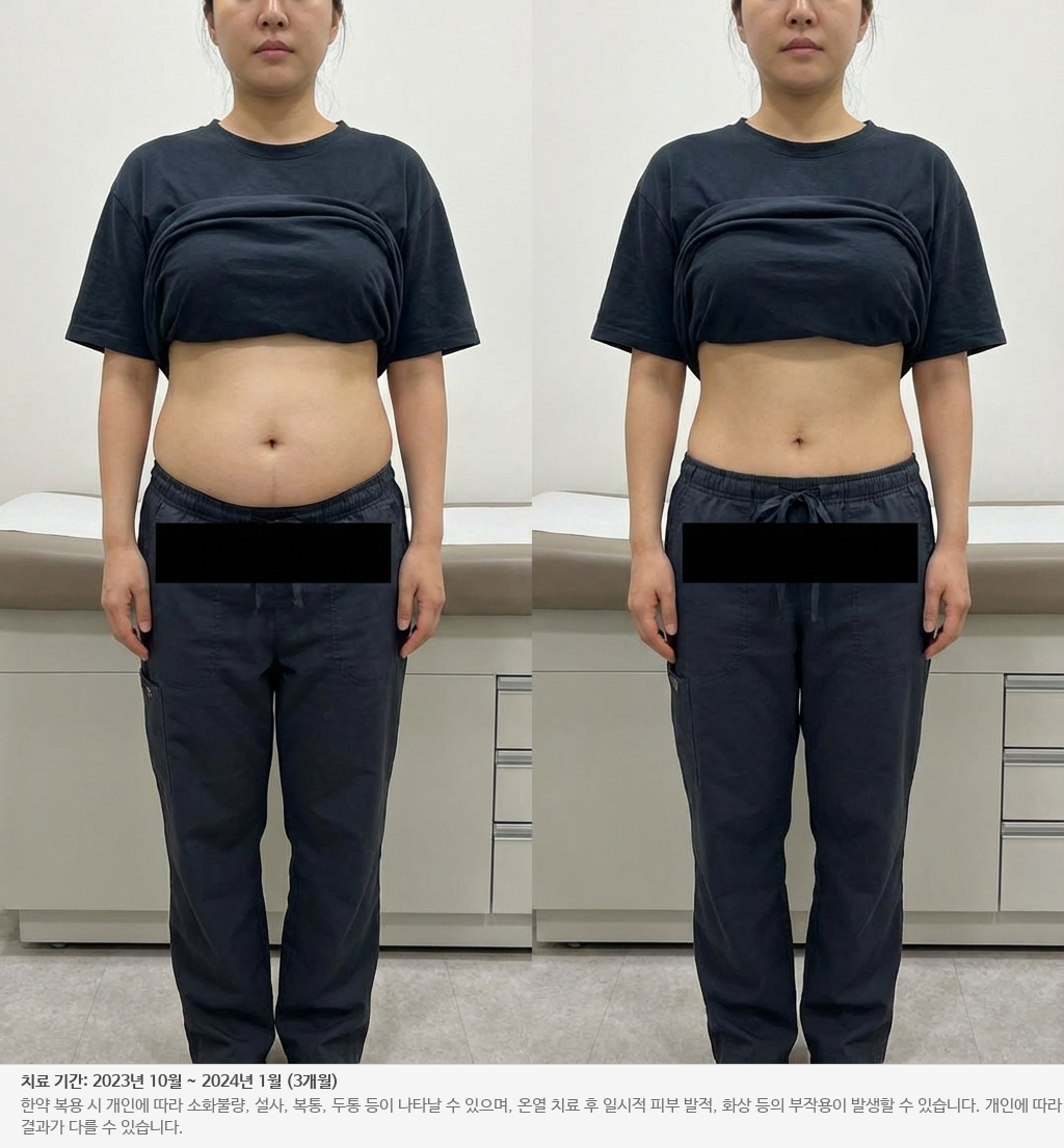 아랫배 다이어트 전후