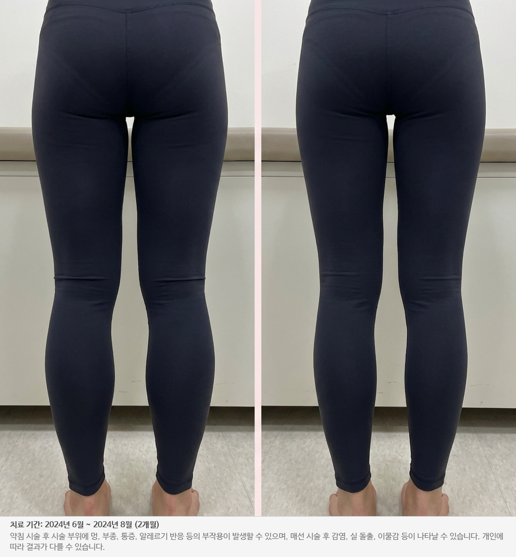 종아리 알 전후