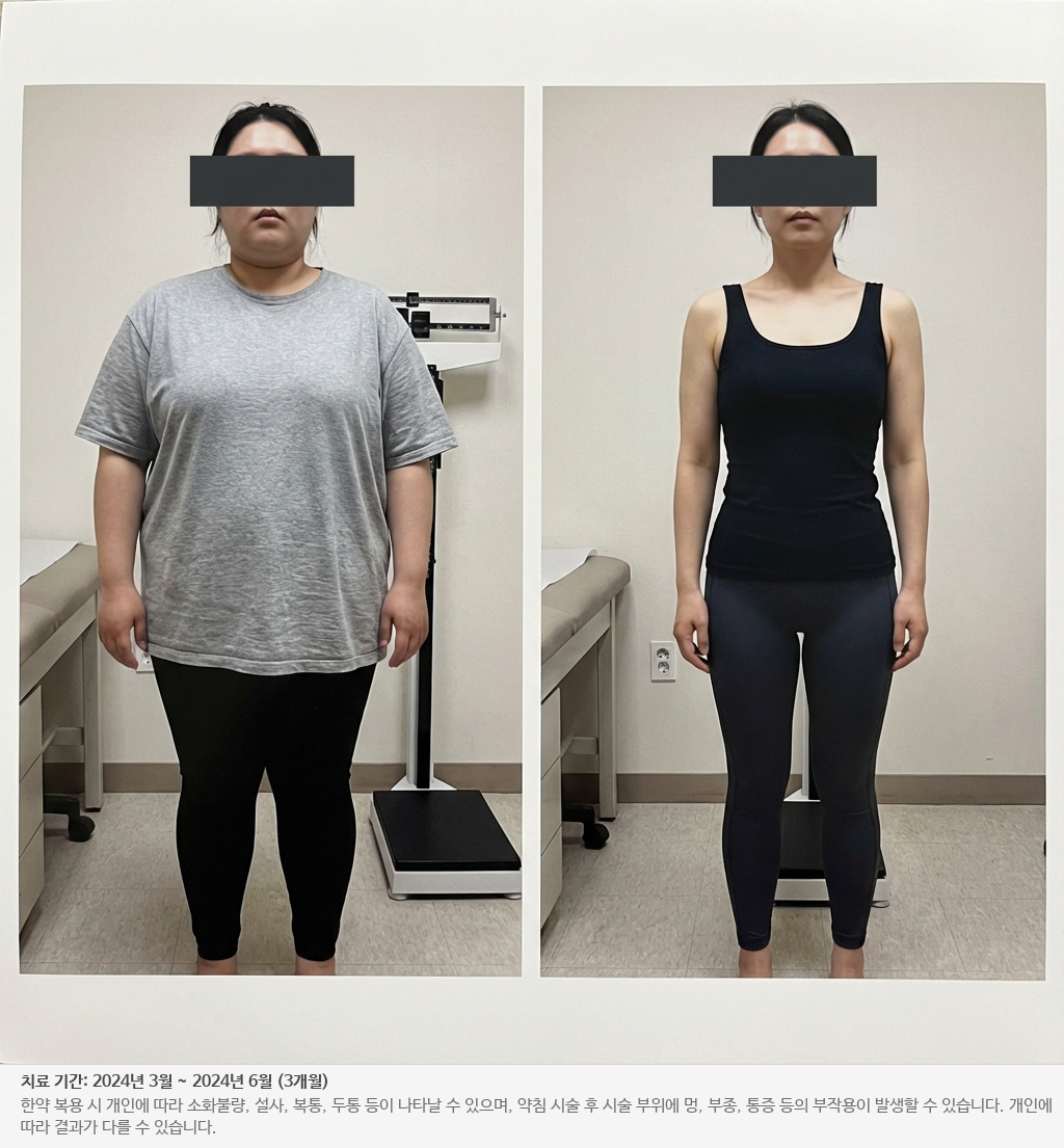 고도비만 다이어트 전후