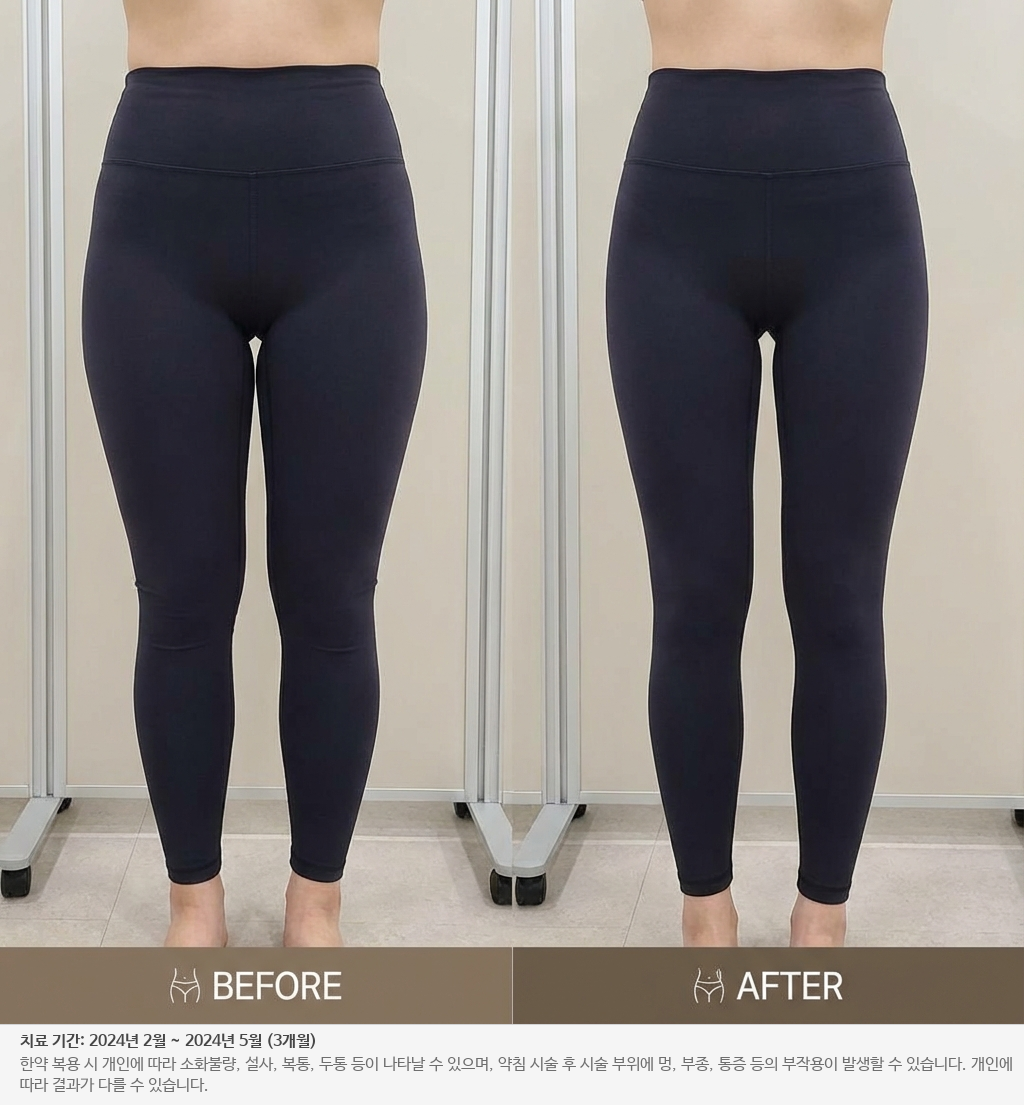 하체 비만 전후