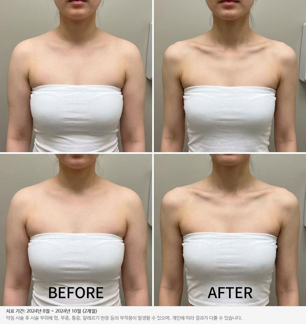 웨딩 다이어트 전후