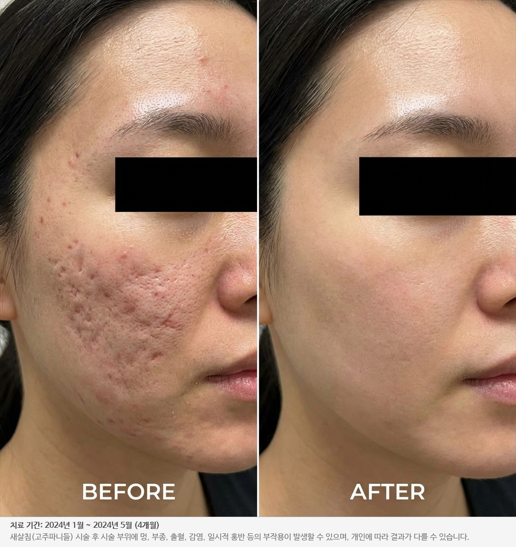 패인 흉터 치료 전후