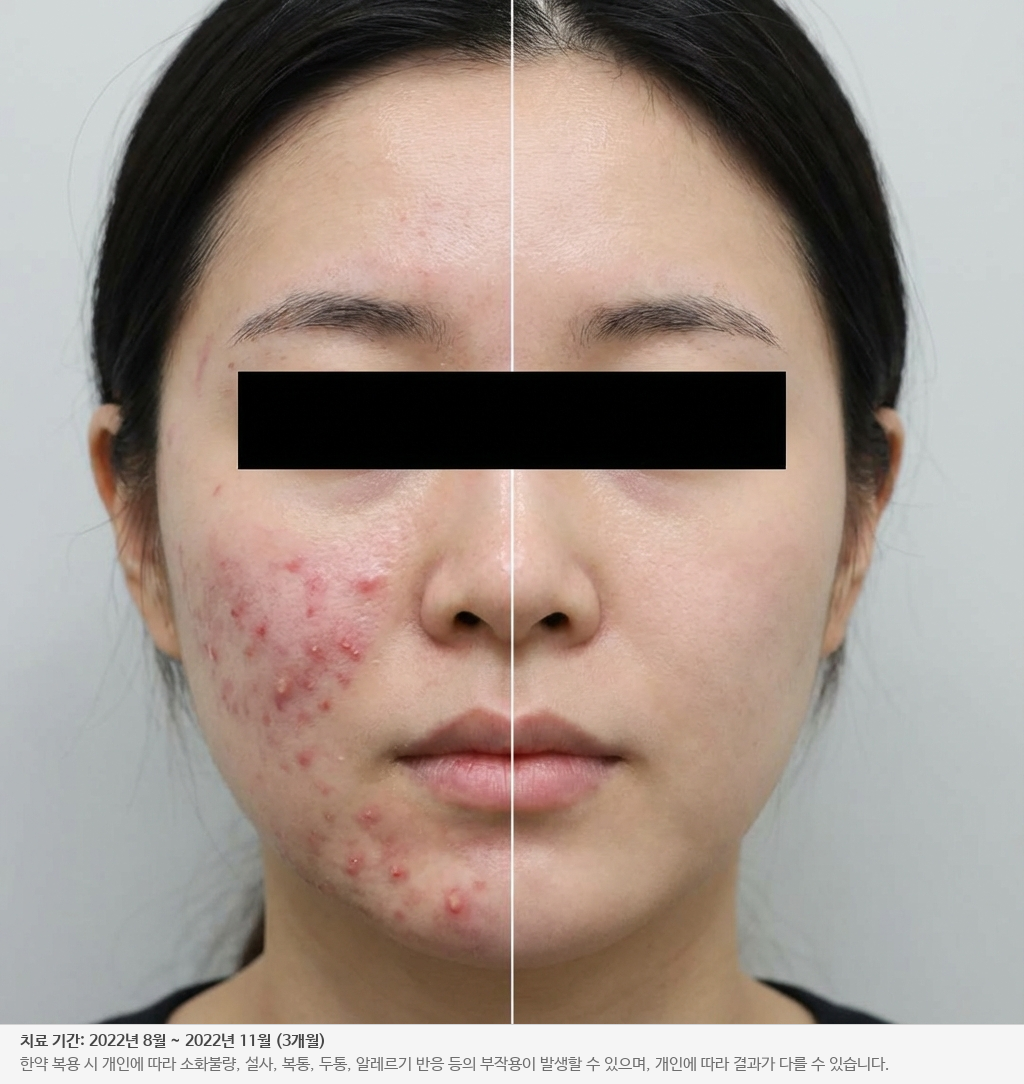 민감성 피부 치료 전후