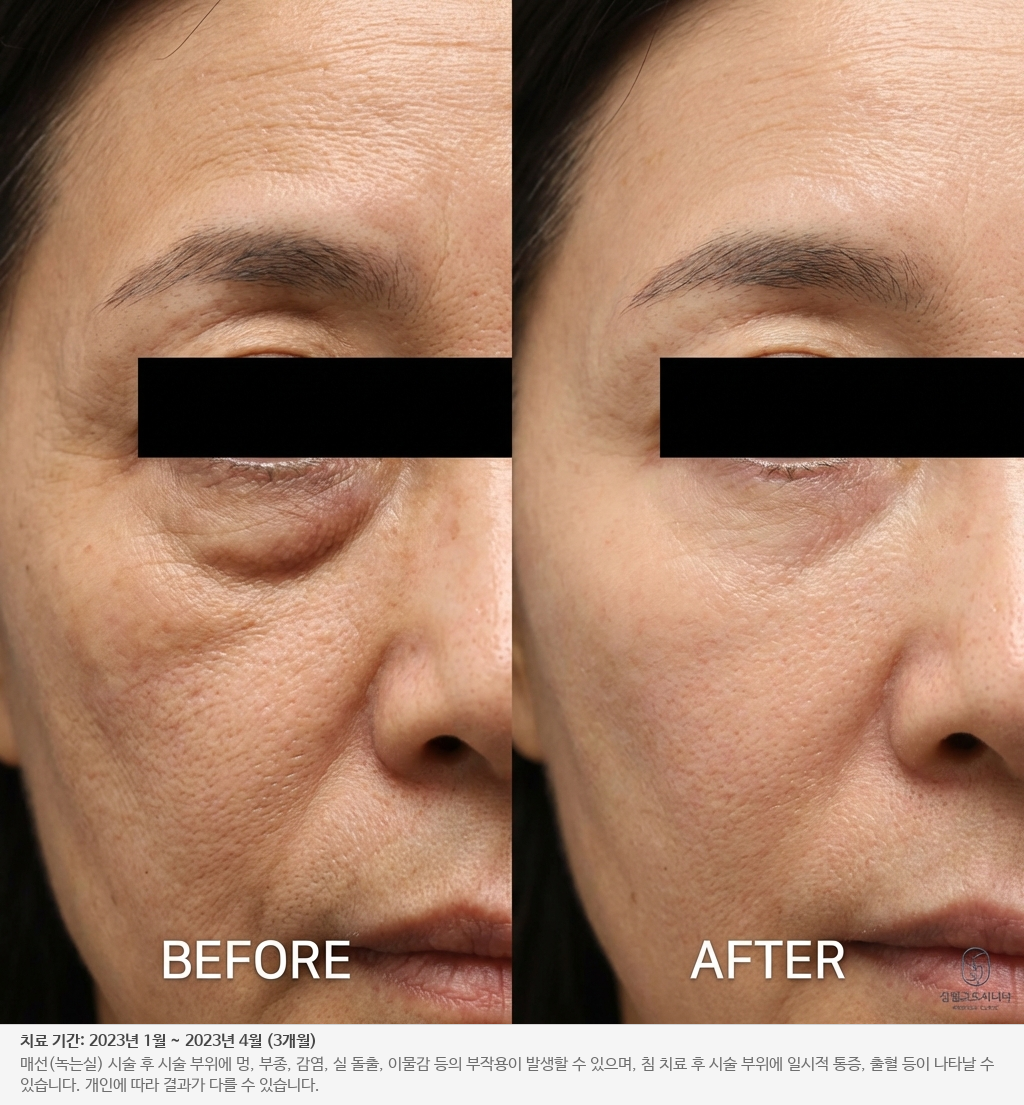 눈가 주름 전후