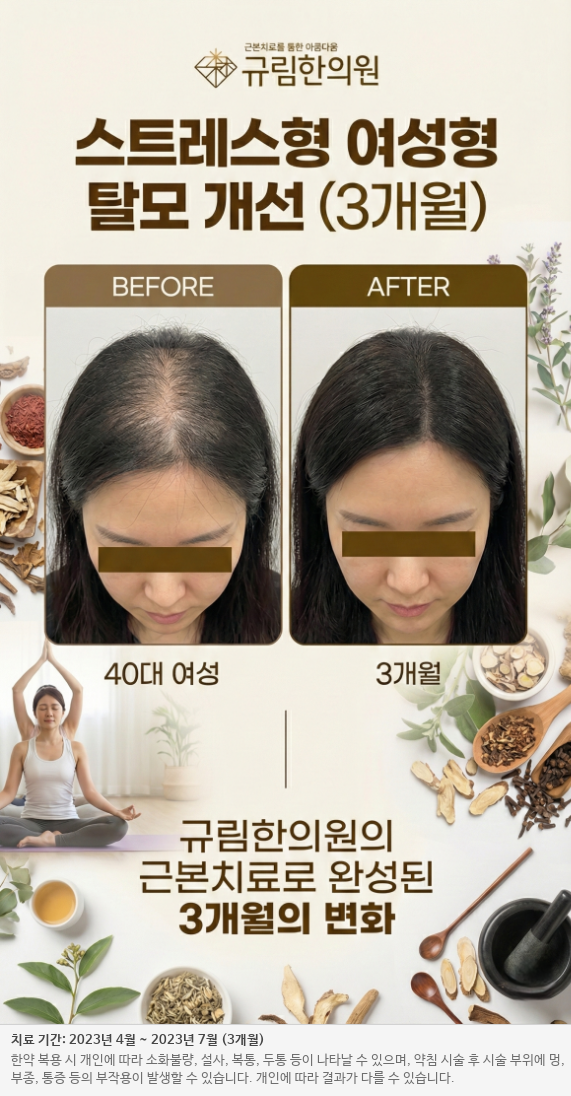 여성 탈모 전후