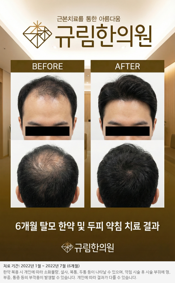 남성 탈모 전후