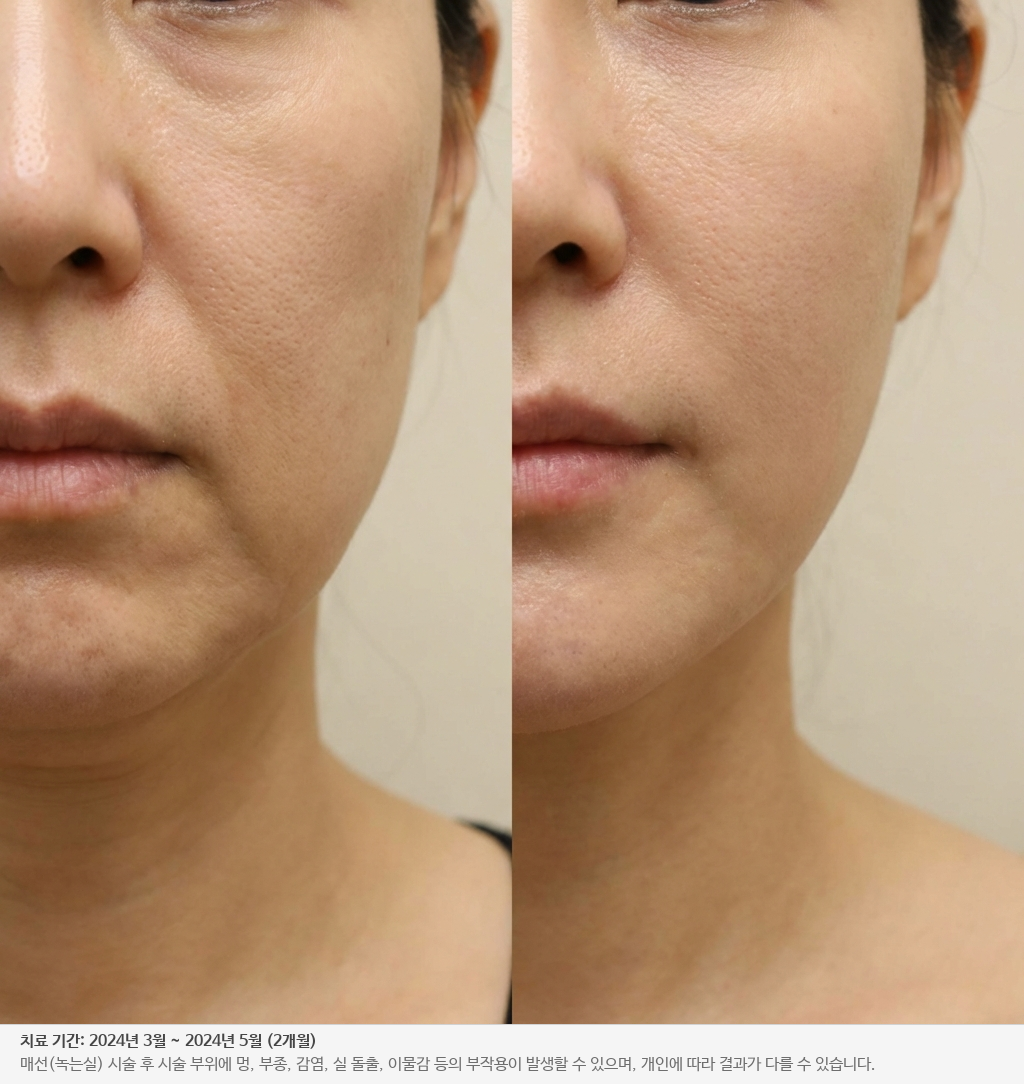 동안 리프팅 전후