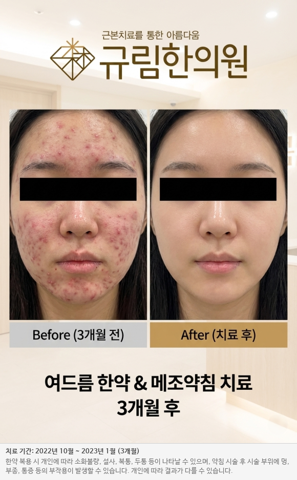 여드름 치료 전후